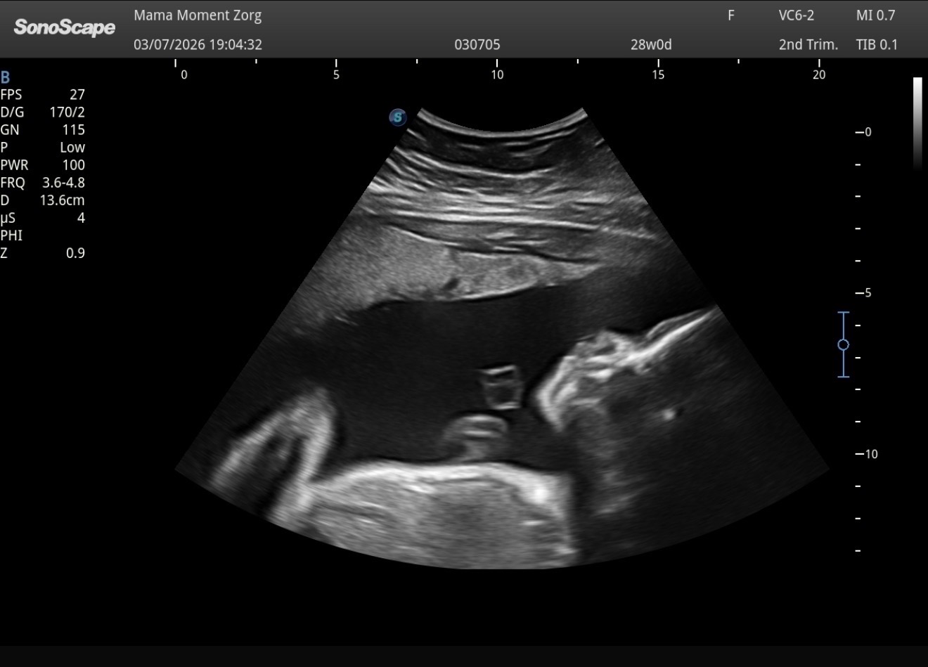 Echobeeld van een baby van 28 weken gemaakt tijdens een pretecho bij Mama Moment Zorg in Bergen op Zoom